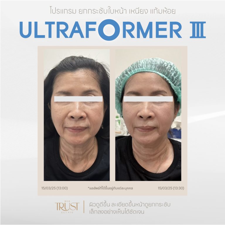 Ultraformer07