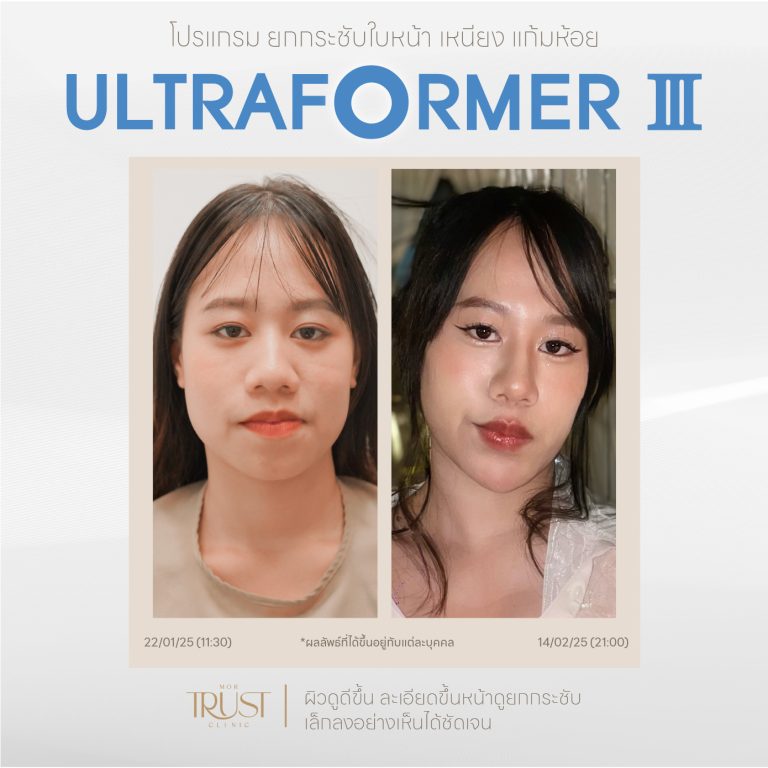 Ultraformer10