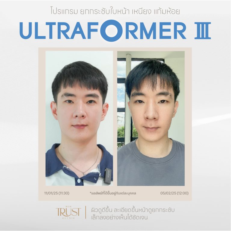 Ultraformer11