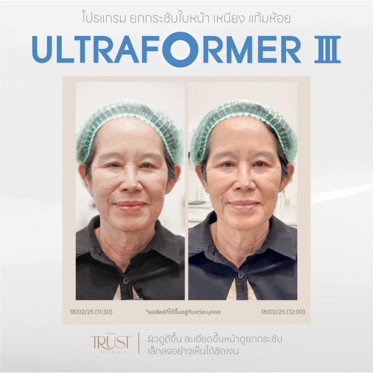 Ultraformer12