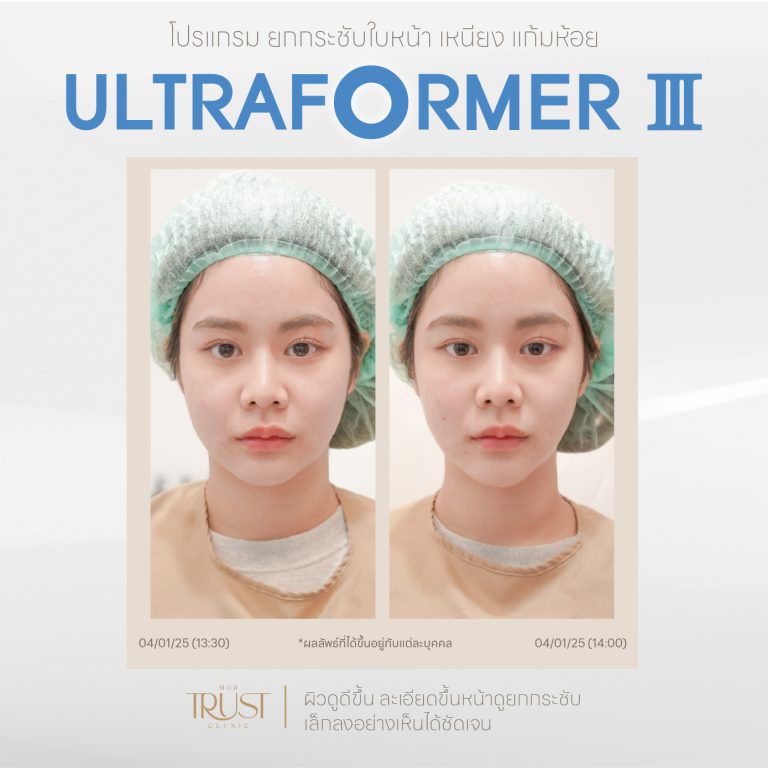 Ultraformer14