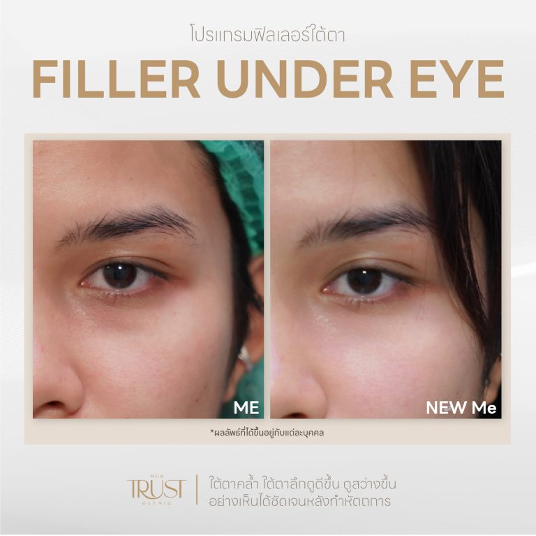 Undereye01