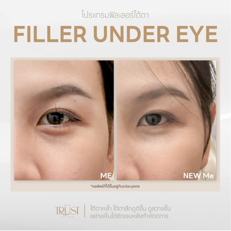 Undereye02