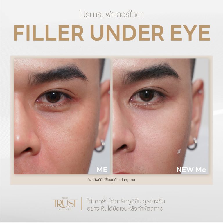 Undereye03