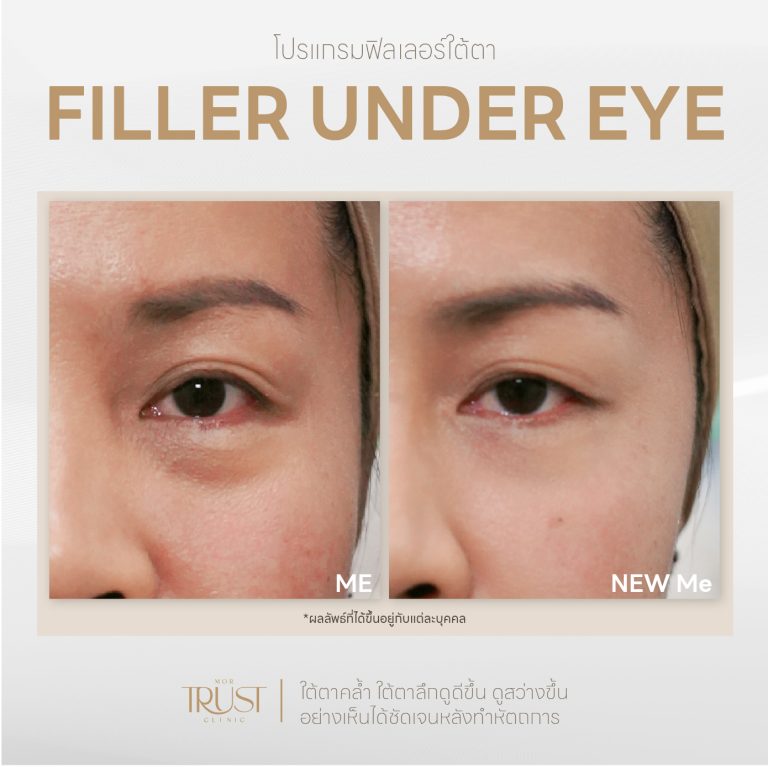 Undereye04