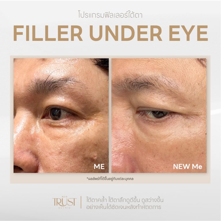 Undereye06