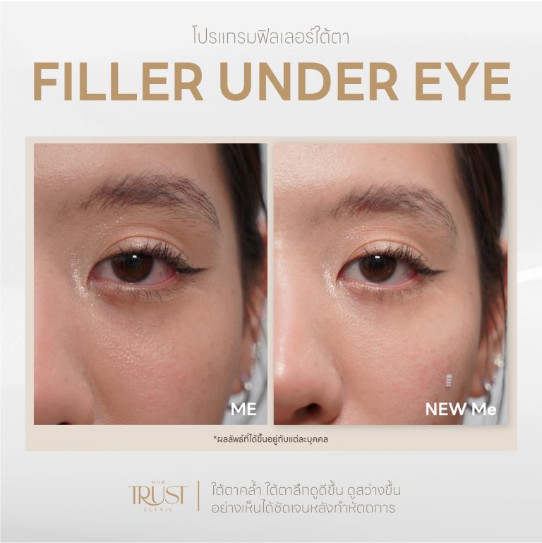 Undereye07