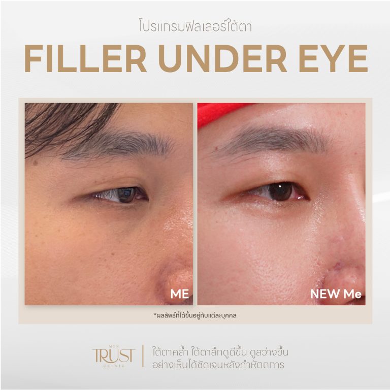Undereye08