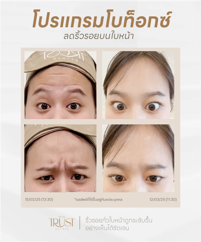 รูป Before & After โบท็อก เชียงใหม่