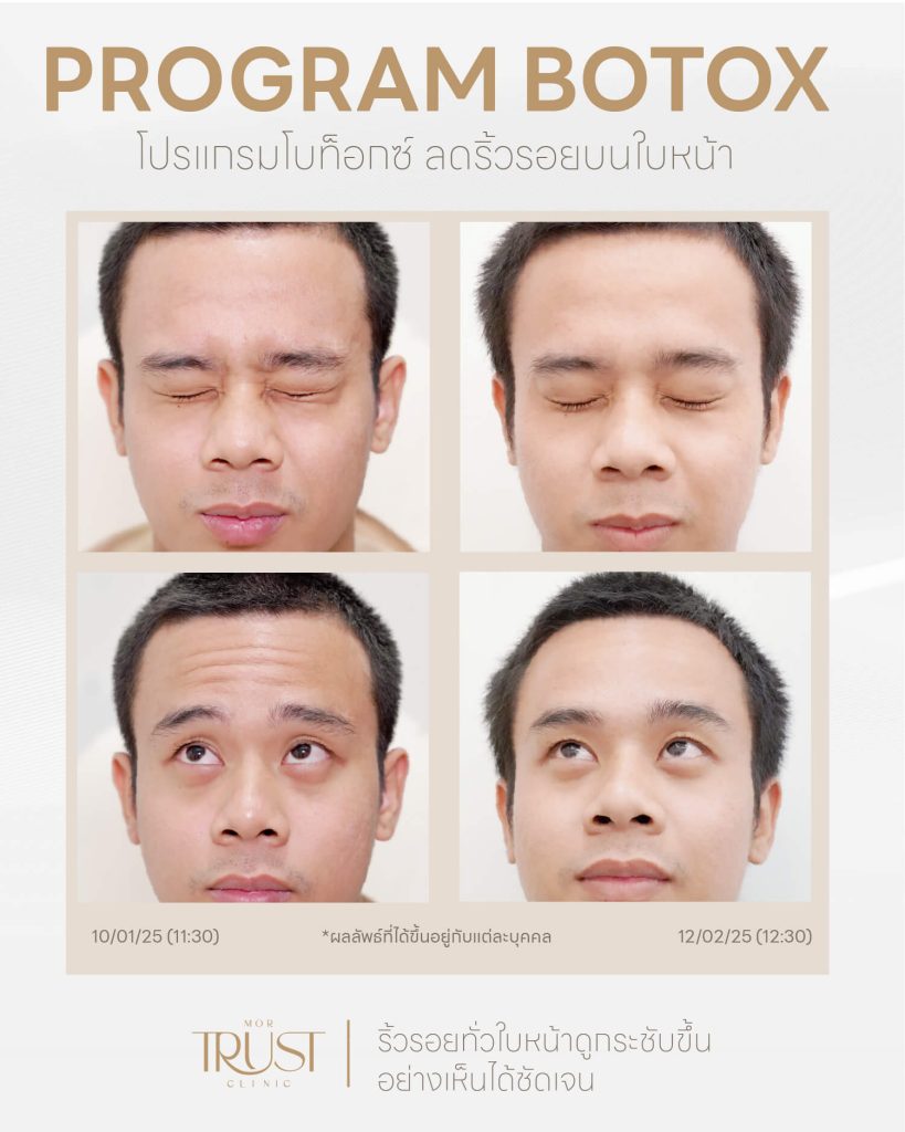 รีวิว Before & After โบท็อก เชียงใหม่