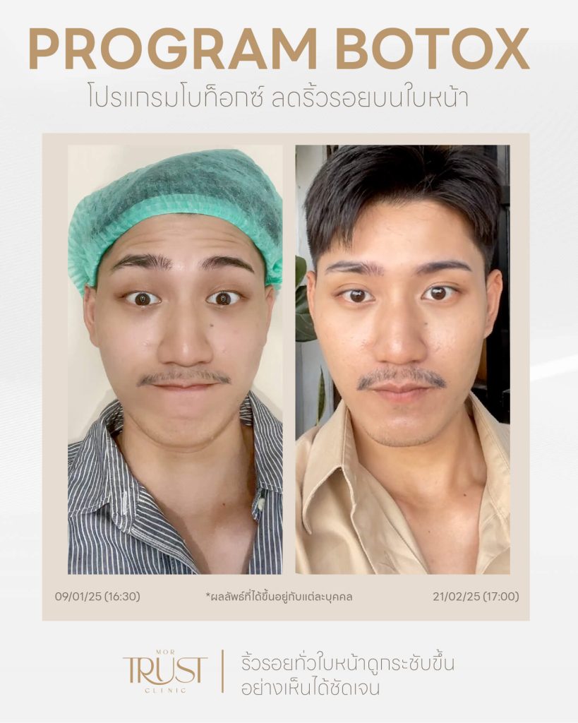 รีวิวลูกค้า Before & After โบท็อก เชียงใหม่