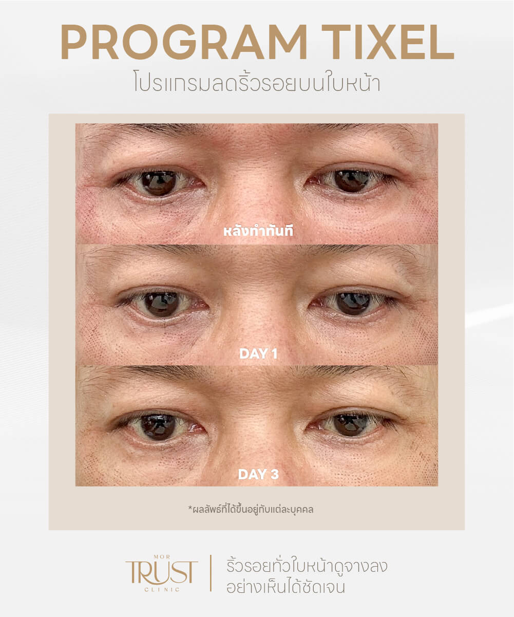 รักษาหลุมสิวเชียงใหม่