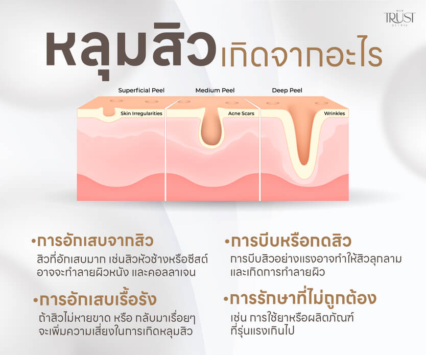 หลุมสิว เกิดจาก
