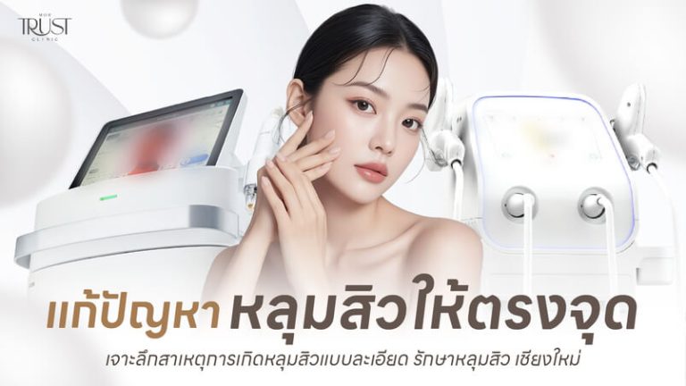 แก้ปัญหาหลุมสิวให้ตรงจุด รักษาหลุมสิว เชียงใหม่ ที่ไหนดี?