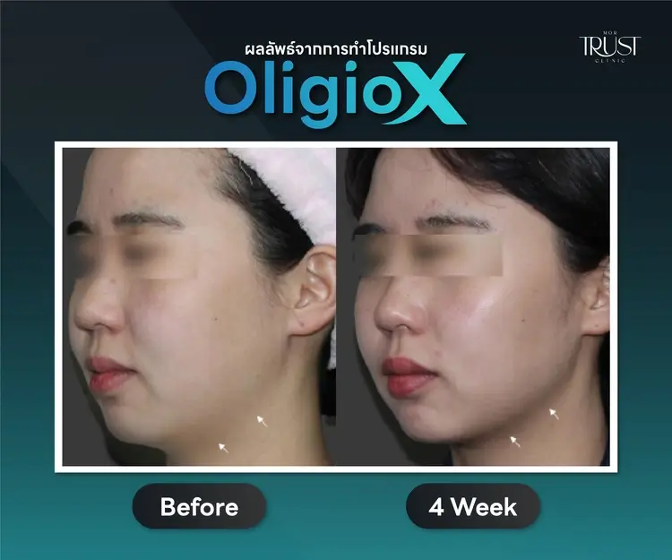 รีวิว Oligio X