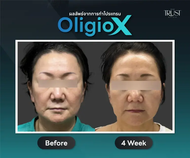 before-after oligio x